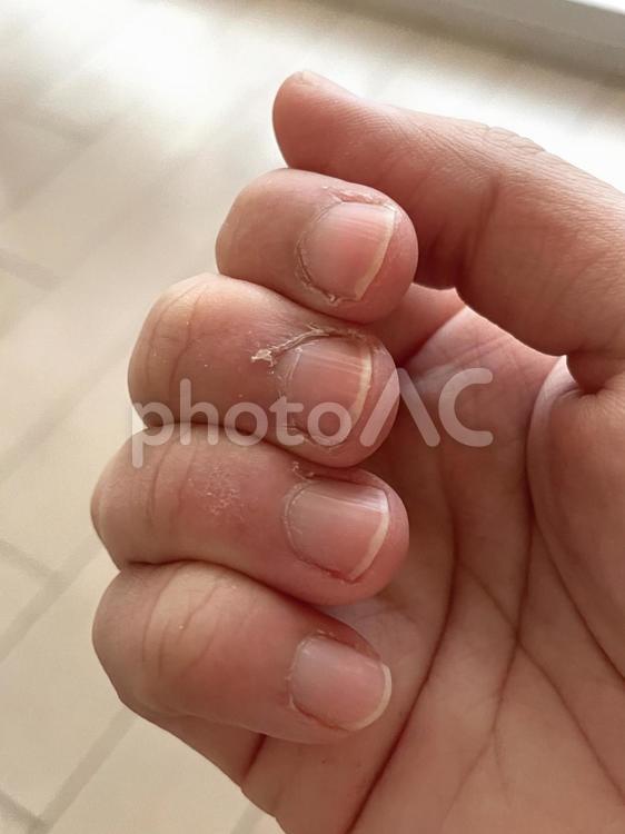 指のささくれ（1） 手,指,ささくれの写真素材