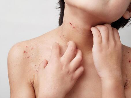 Image of children's atopy, dry skin, and dermatitis, JPG Image of children's atopy, dry skin, and dermatitis, dry skin, atopic, itchy, JPG