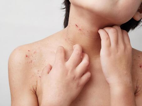 Image of children's atopy, dry skin, and dermatitis, kulit garing, atopy, gatal, JPG