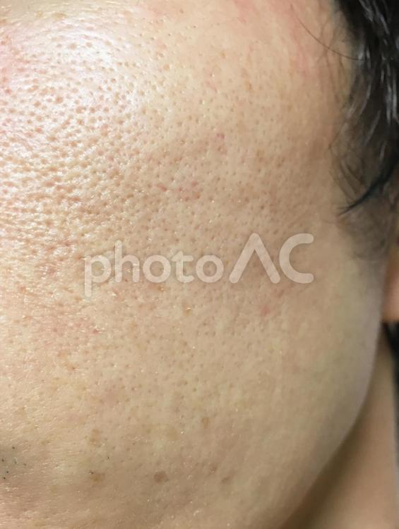 肌トラブル　吹き出物やシミのある男性の顔　01 メンズ美容,スキンケア,メンズスキンケアの写真素材