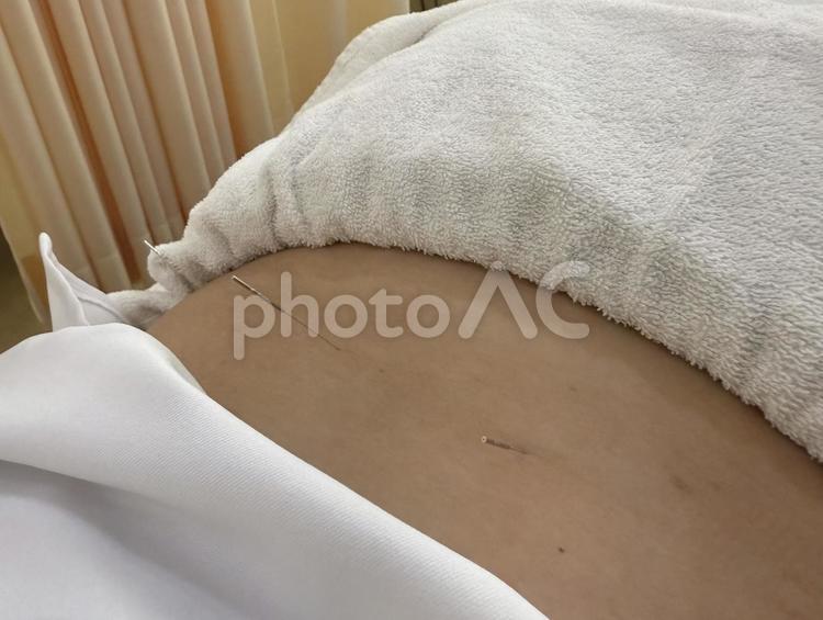 鍼灸治療 腰痛,鍼灸,はりの写真素材