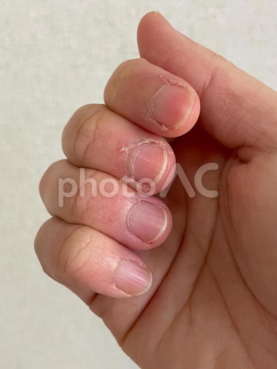 指のささくれ（2） 指,ささくれ,手の写真素材