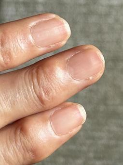 ネイルトラブルで二枚爪になっちゃった(縦 ネイルトラブルで二枚爪になっちゃった(縦 つめ,二枚爪,割れるの写真素材