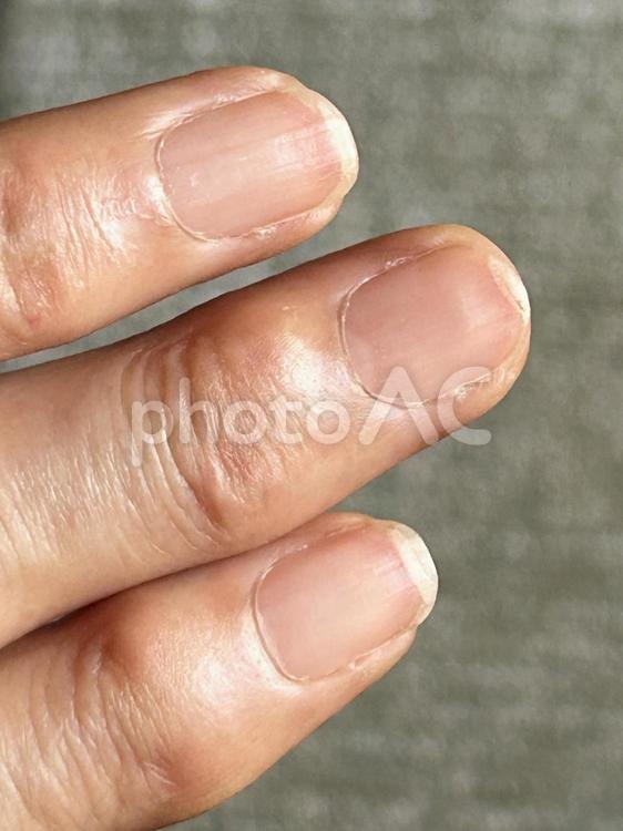 ネイルトラブルで二枚爪になっちゃった（縦 つめ,二枚爪,割れるの写真素材