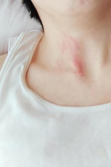 Photo, urticaria, skin, itch, 