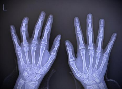 手のレントゲン レントゲン,手,骨の写真素材