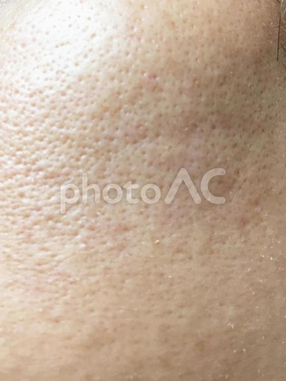 肌トラブル　吹き出物やシミのある男性の顔　06 メンズ美容,スキンケア,メンズスキンケアの写真素材
