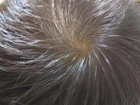 scalp scalp