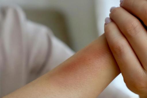 内出血のある女性の手 内出血のある女性の手 内出血,皮下出血,注射の写真素材