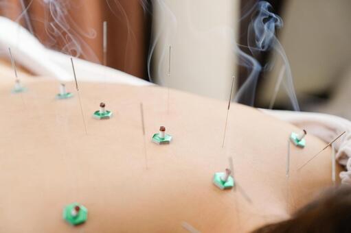 A woman with a needle stuck in her back at a bright acupuncture clinic, acupuntura, aguja, acupuntura, JPG