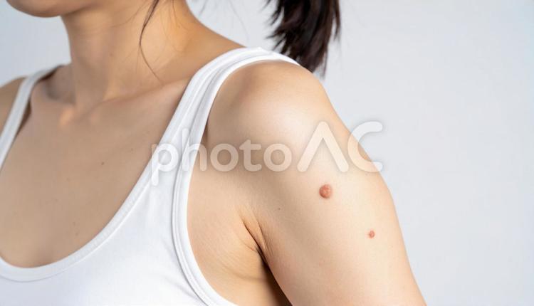 女性の二の腕にできた大きなおでき おでき,二の腕,皮膚病の写真素材