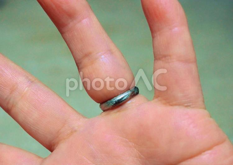 結婚指輪　抜けない指輪　外れない指輪  指輪が食い込んだ指 指輪,抜けない指輪,食い込みの写真素材