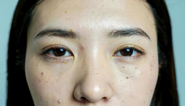 女性の目のまわりにできたブツブツ 稗粒腫 女性の目のまわりにできたブツブツ 稗粒腫の写真